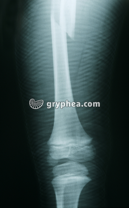 Radiographie de Fémur fracturé  - gryphea.com